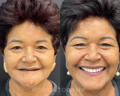 Implantodontia_antes e depois_3