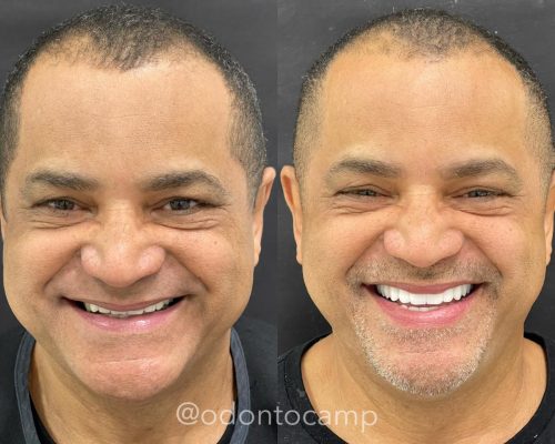 Prótese dental_antes e depois_2
